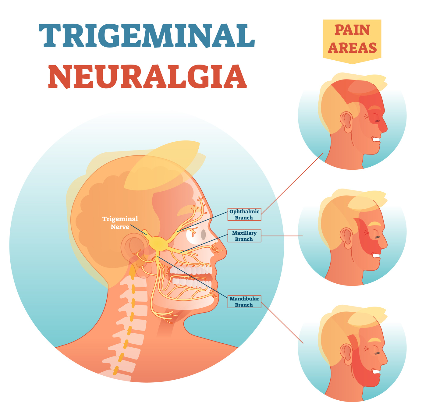 U1253 - Therapeutic failure in trigeminal neuralgia