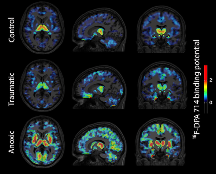 Molecular imaging & coma