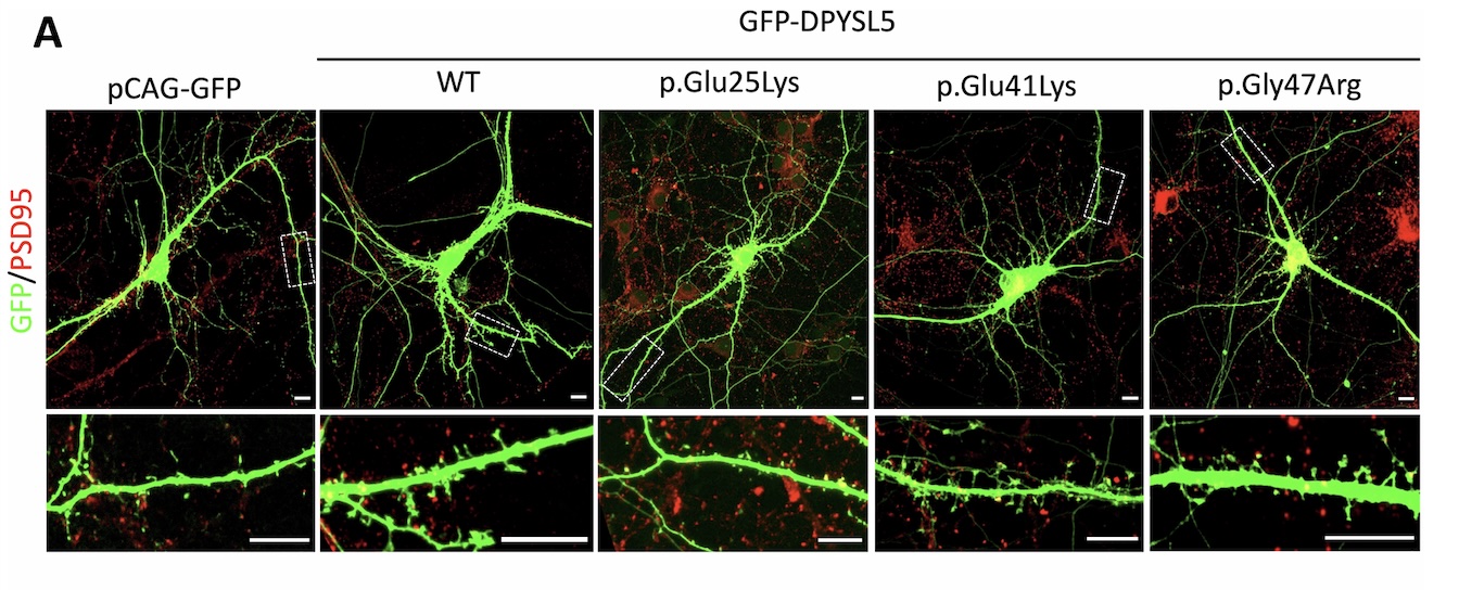 Missense variants in DPYSL5 associated with neurodevelopmental disorders and brain malformations cause impaired neuronal maturation in vitro